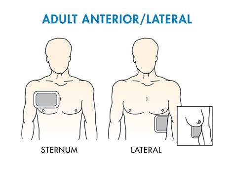 AED Pad Placement | Where to Put Pads on Adults & Children