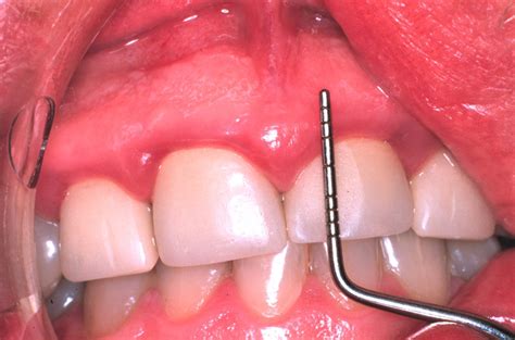 RETRACTED ARTICLE: Gingival health in relation to clinical crown length: a case report | Cases ...