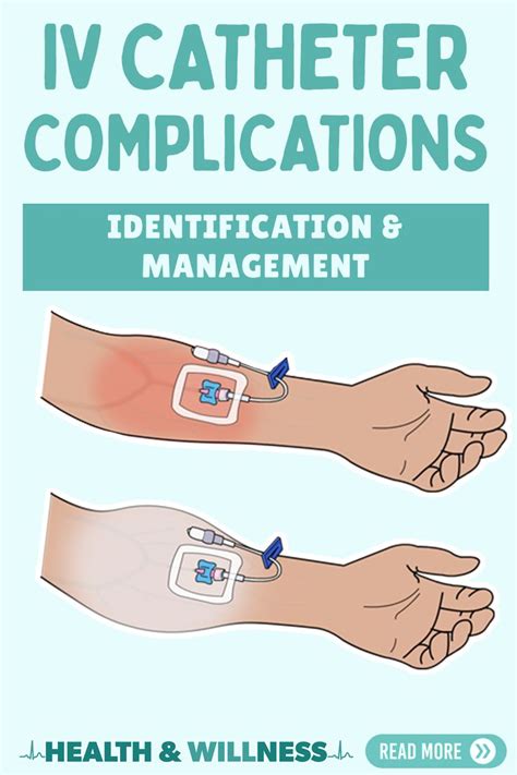 IV Infiltration and other IV Catheter Complications: Identification and Management | Health And ...