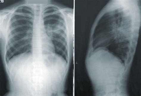 A neural network can help spot Covid-19 in chest x-rays | MIT Technology Review