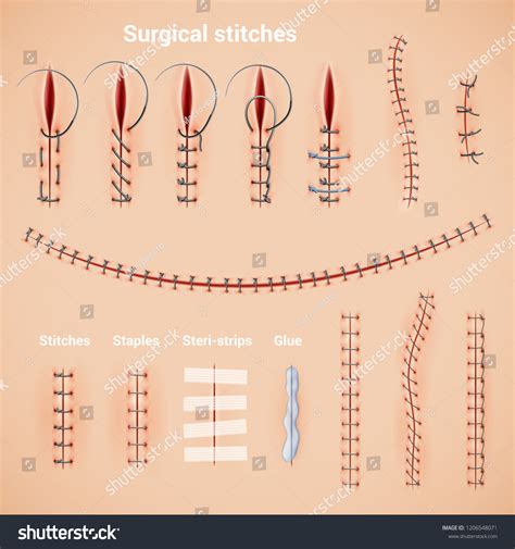 Surgical staples 1,112 รายการ ภาพ ภาพสต็อกและเวกเตอร์ | Shutterstock