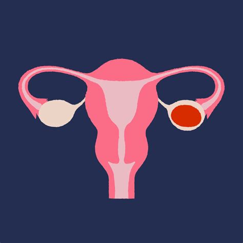 Can a retroverted uterus change to an anteverted uterus without pregnancy? : r/UterusProblems