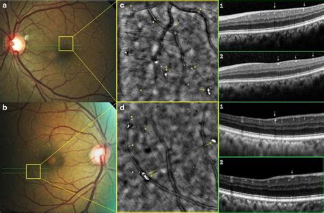 High-resolution adaptive optics findings in talc retinopathy | SpringerLink