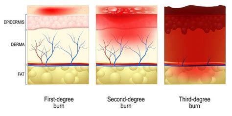 Serious Burn Injuries in Montana: Getting Legal Help