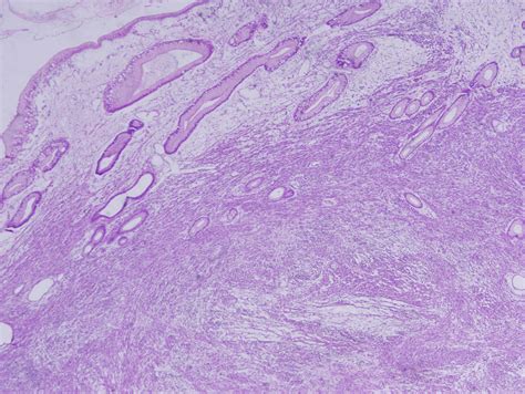 Pathology Outlines - Leiomyosarcoma