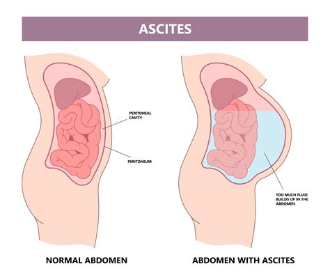 Ascites from Drinking Alcohol - Rehab Guide