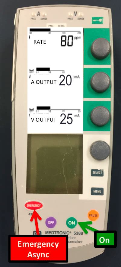 Dr. Smith's ECG Blog: Emergency Transvenous Cardiac Pacing