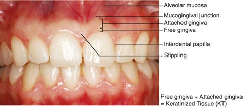 Definition of Gingival Recession and Anatomical Considerations ...