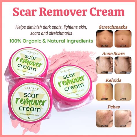 Keloid & Stretch mark Remover Cream Scar Remover Cream MIRACLE CREAM PEKLAT CREAM by VERDEFY ...