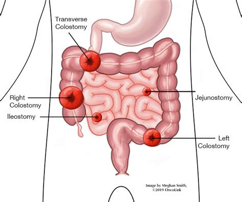 Surgical Procedures: Ileostomy | OncoLink