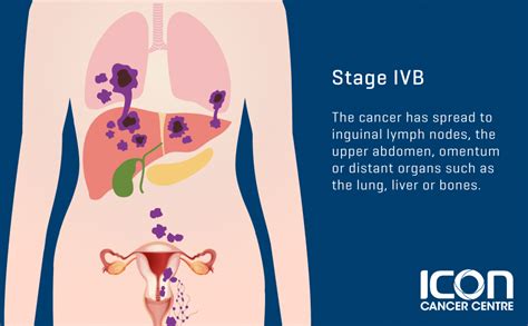 Stages Of Uterine Cancer