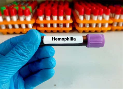 Novo Nordisk achieves positive data with two hemophilia candidates ...