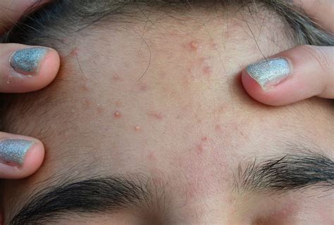 Bumps on Forehead: 8 Home Remedies to Reduce It