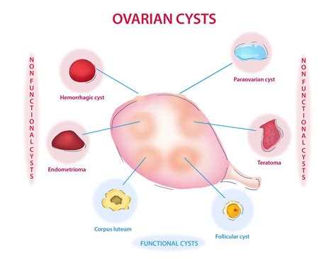 What are cysts, anyway? — Mother Nurture Wellness