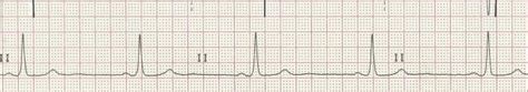 ECG Basics: Sinus Bradycardia | ECG Guru - Instructor Resources