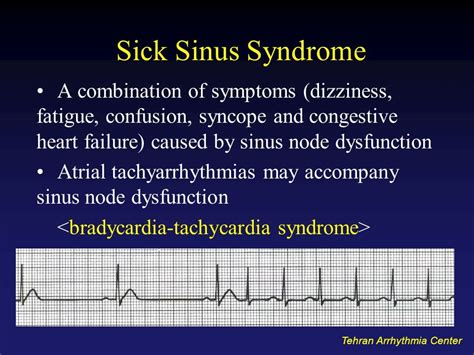 Pin by nonas arc on Sick Sinus Syndrome | Nursing mnemonics, Cardiac ...