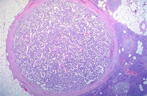 Adenoma, Islet Cell; Nesidioblastoma; Islet Cell Tumor