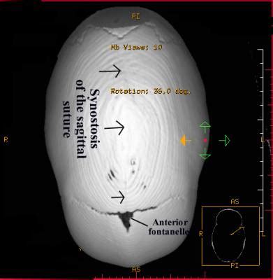 Scaphocephaly