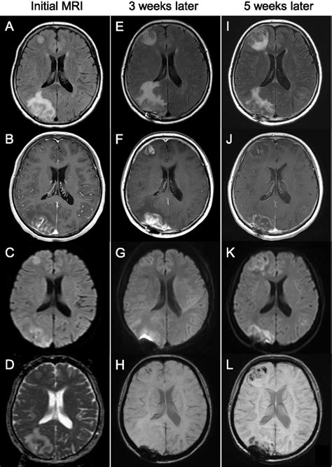 Neuroradiologic MRI findings. Magnetic resonance imaging (MRI) of the ...