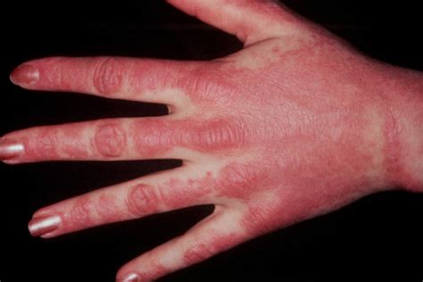 Mechanic's hands in a patient with dermatomyositis. Image reprinted ...