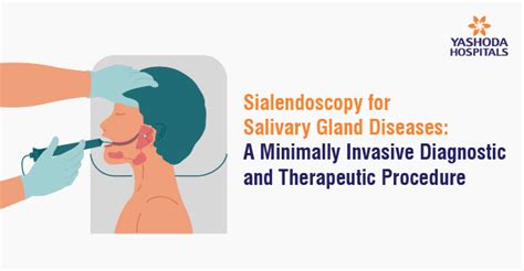 Sialendoscopy for Salivary Gland Diseases: A Minimally Invasive ...