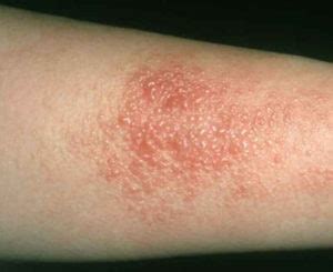 Contact Dermatitis - North Texas Allergy & Asthma Center