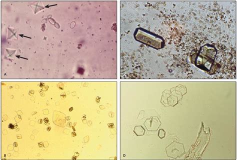 Uric Acid Crystals In Urine