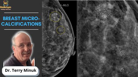 Breast Microcalcifications | Mammography | Dr. Terry Minuk | RadioGyan