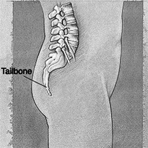 Bruised tailbone - Symptoms, Causes, Treatment, Healing time | HubPages