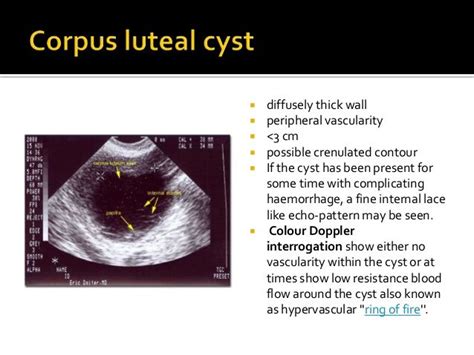 Corpus Luteum Cyst Rupture During Early Pregnancy - PregnancyWalls