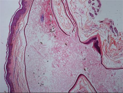 Top 111 + Eruptive vellus hair cysts cause - polarrunningexpeditions