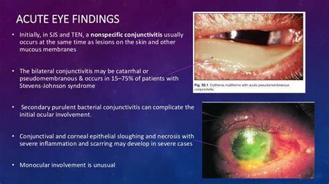 Ocular cicatricial pemphigoid, Stevens-Johnson Syndrome, Toxic Epider…