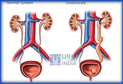 Best Cost Ureterocele Surgery Treatment Surgery in India Top Hospital Surgeon Delhi, Mumbai ...