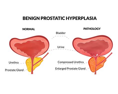 Early Signs of Benign Prostatic Enlargement - Enlarged Prostate ...