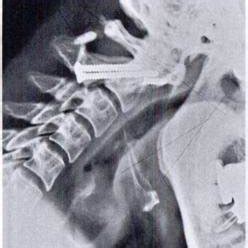 (PDF) Atlanto-axial fusion with transarticular screw fixation