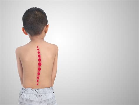 One-Third of U.S. Kids Have Back Pain, Study Says - Comprehensive ...