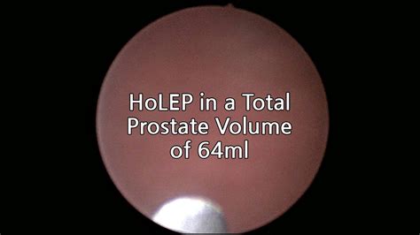 Routine HoLEP Procedure with Dr. Oh (64ml) - YouTube