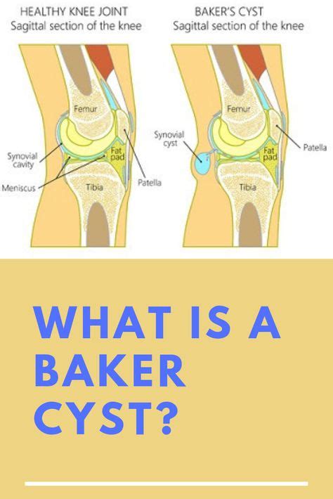 What is a Baker Cyst? | Baker's cyst, Cysts, Synovial fluid