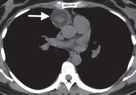 Mediastinal Masses | Radiology Key