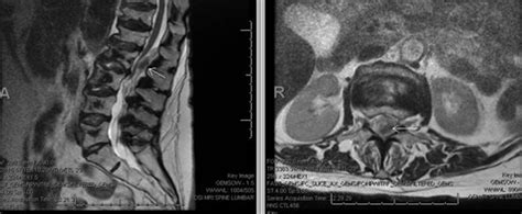 Lumbar Epidural Hematoma after Neuraxial Pain Procedure in a Patient ...