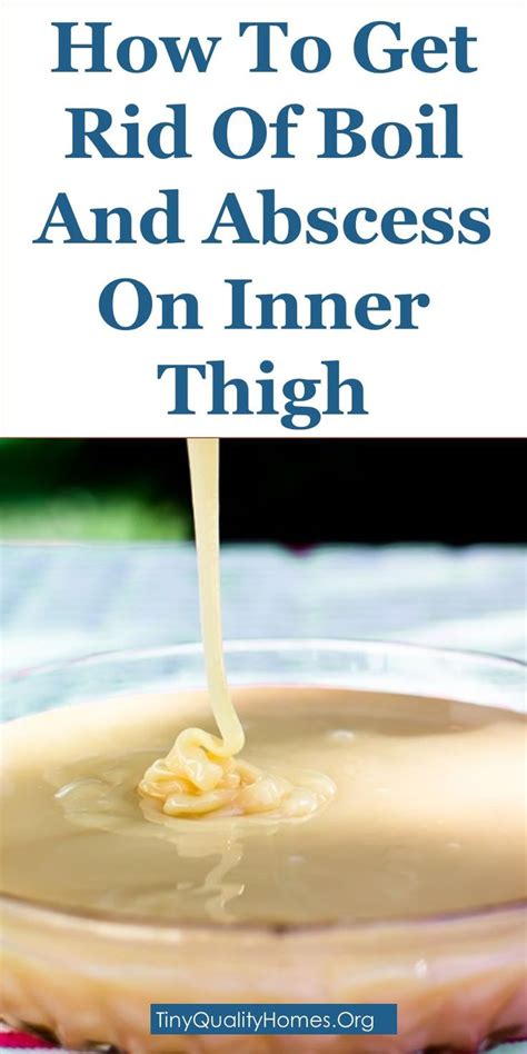 How To Get Rid Of Boil And Abscess On Inner Thigh – 15 Home Remedies: This Guide Shares Insights ...