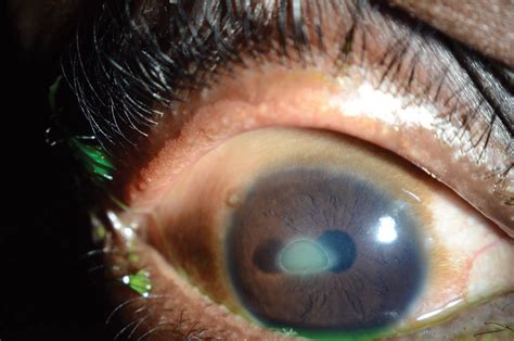 Corneal Manifestations of Systemic Diseases