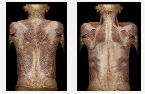 Cadaver Back Muscles Diagram | Quizlet