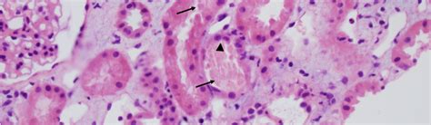 acute tubular necrosis – American Society of Pediatric Nephrology (ASPN)