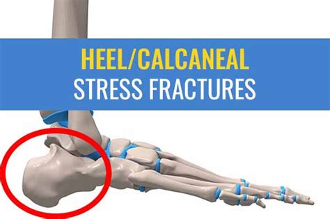 Heel / Calcaneal stress fractures – Causes, symptoms, and treatment