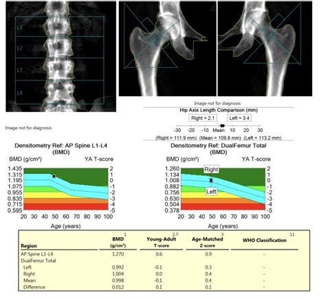 Bone Density Test Chart | My XXX Hot Girl