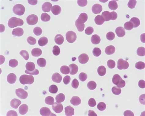 Hereditary Spherocytosis | Medical Laboratories