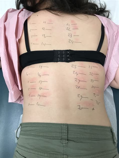 Allergy Test