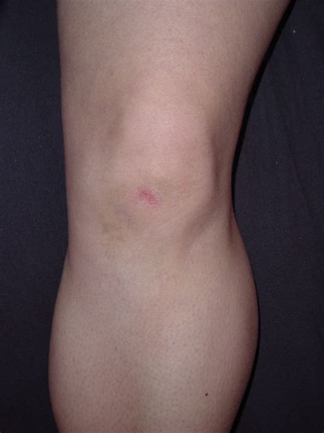 Bruised Knee | So Kate fell on Ice and hit her knee on Thurs… | Flickr