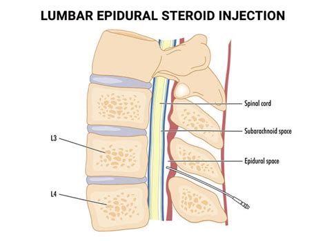 Epidural Space